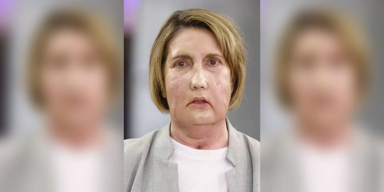 Ισπανία: Η πρώτη μεταμόσχευση προσώπου με δότρια που υποβλήθηκε σε υποβοηθούμενη ευθανασία